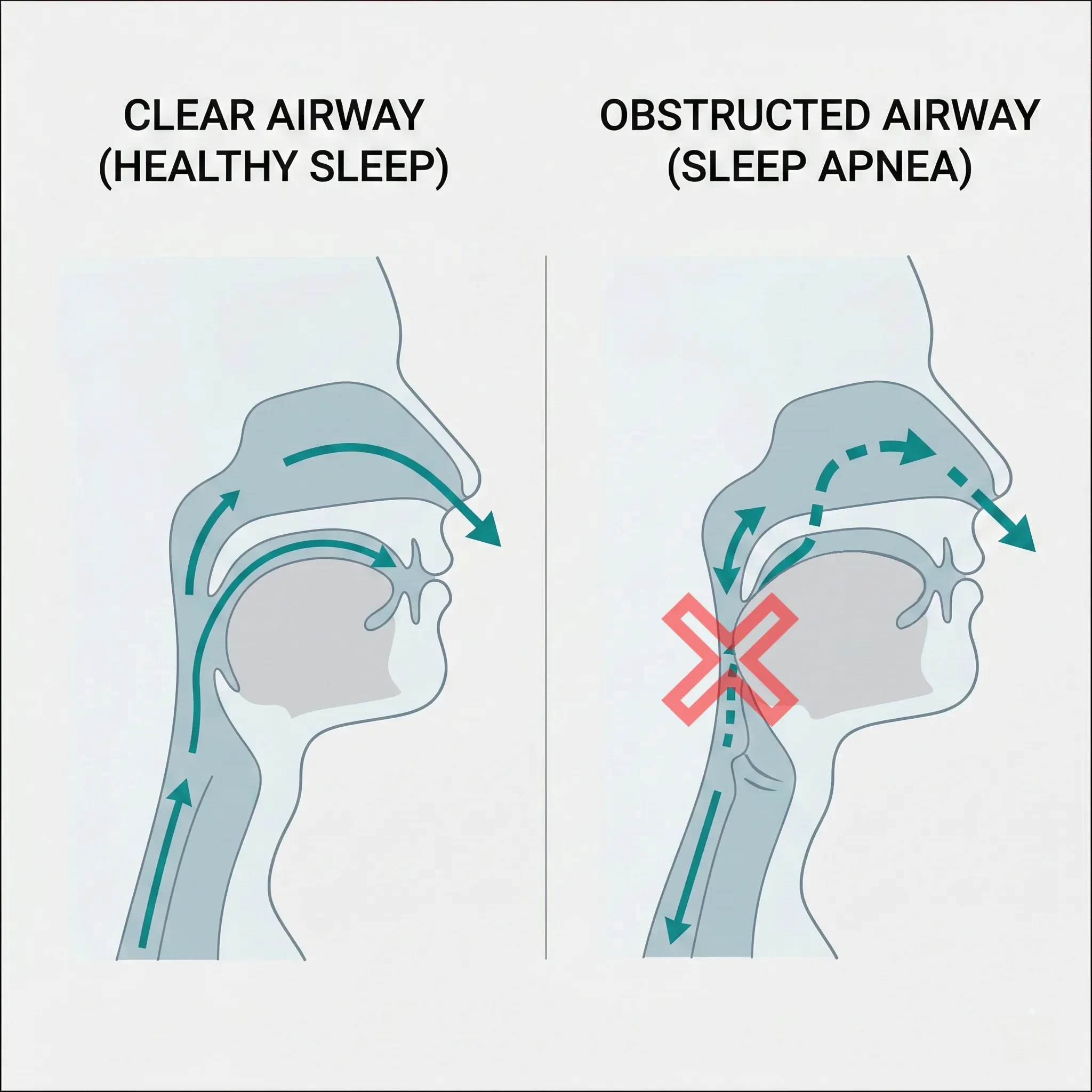 What exactly is Obstructive Sleep 