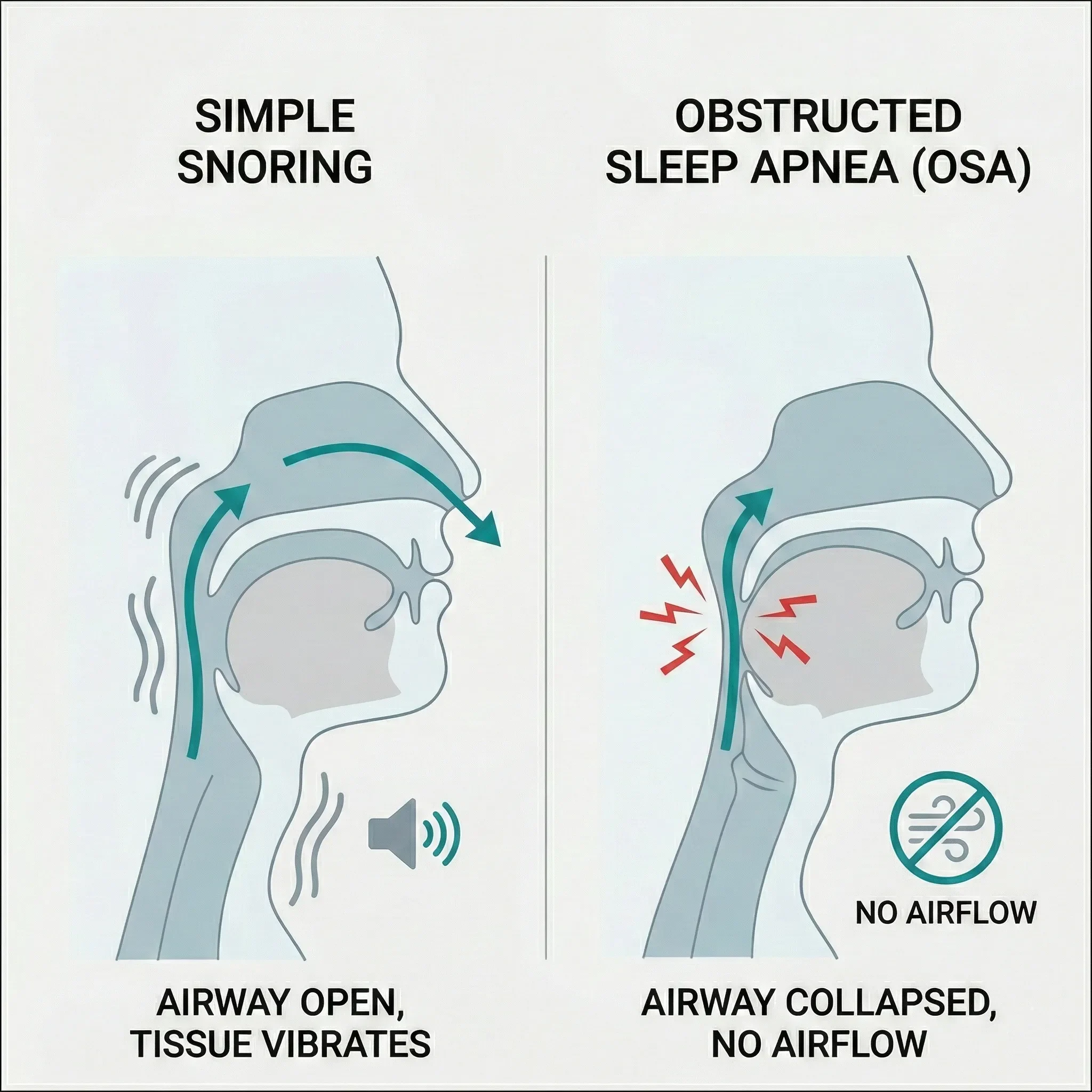 Is snoring always a sign of sleep apnea
